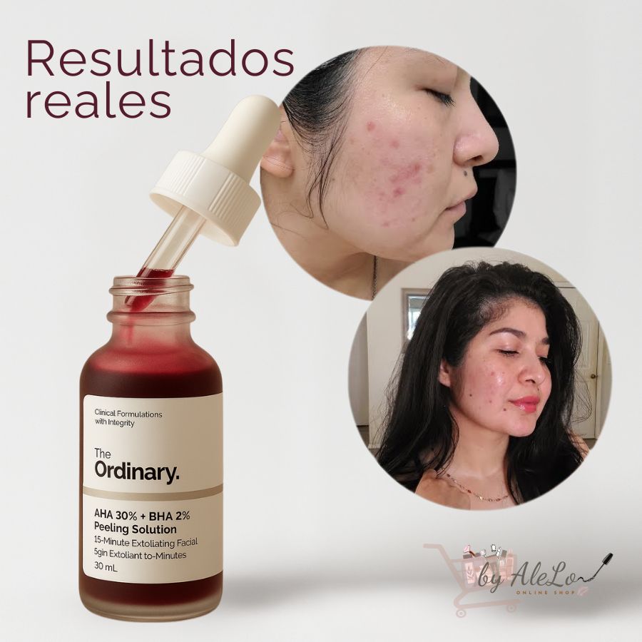 The Ordinary Peeling AHA 30% + BHA 2% – 🌺 Renovación Suprema